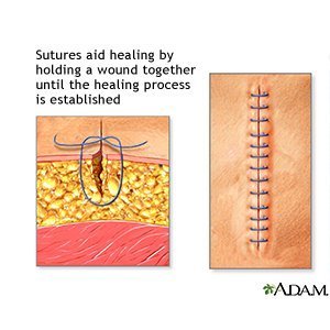wound absorbable discharge infected ddccdn
