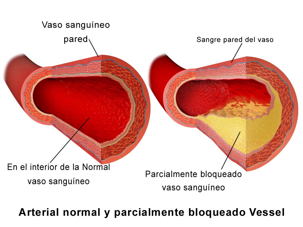 valvulas del corazon tapadas y arterias