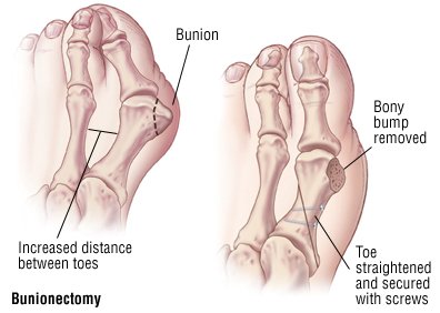 Bunions Callous