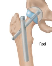hip fracture leg rod surgery metal tibia after when treatment options guide symptoms fractures professional call causes left drugs health