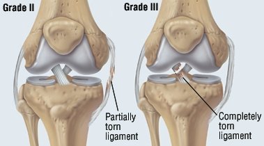 acl sprain