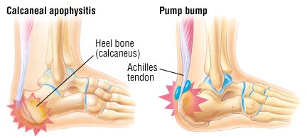 Heel Discomfort