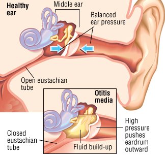 Mastoid bone infection