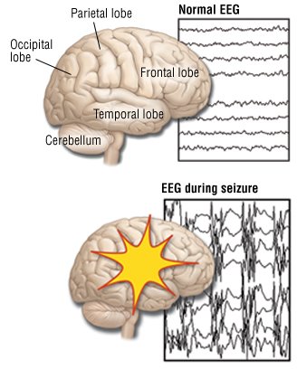 Partial Seizures (Focal Seizures)