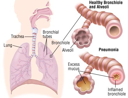 Pneumonia Guide: Causes, Symptoms and Treatment Options