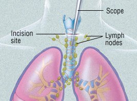 Lung Lymph Nodes