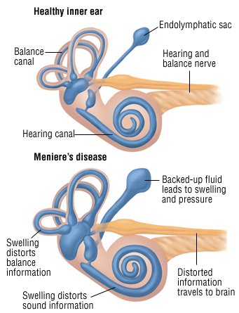 Steroid injection in ear for meniere's