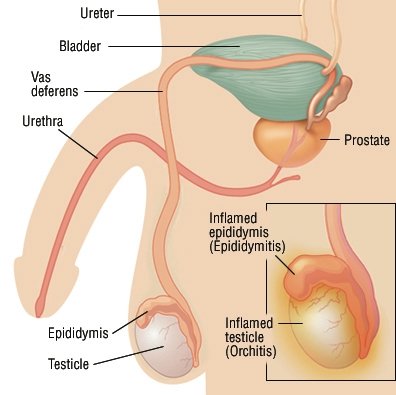 Epididymitis Orchitis