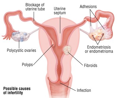 Female causes of Infertility