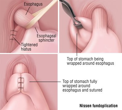 Endoscopy treatments