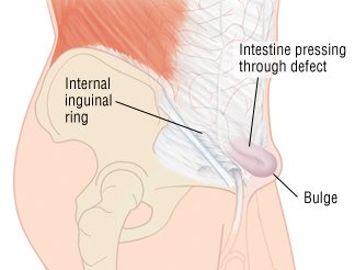 Direct on Direct Inguinal Hernia     This Occurs When A Portion Of The Intestine