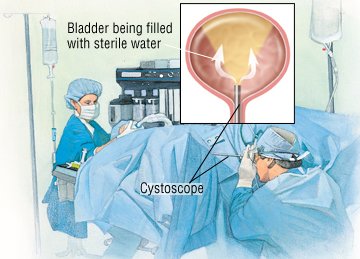 interstitial cystitis guide basics patient expected duration treatment options causes drugs health