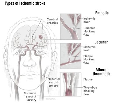 put up stroke occupational therapy sports