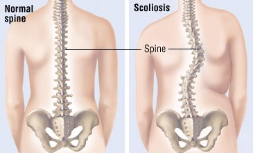 Scoliosis