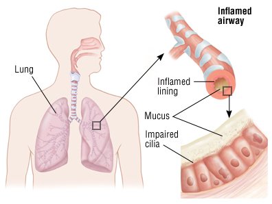 is bronchitis contagious question mark