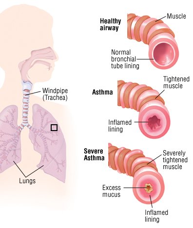 Mechanism of action of corticosteroids in bronchial asthma