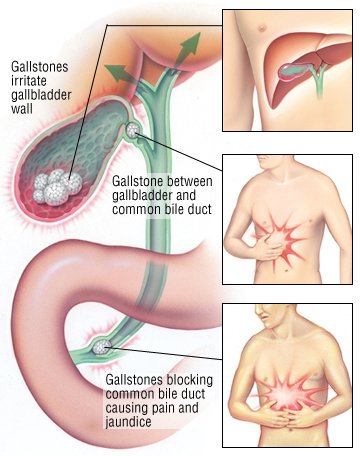 common bile duct obstruction. Bile Duct Diseases