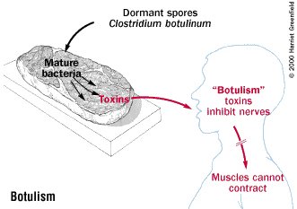 Botulinum Toxin Symptoms Causes