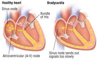 Bradycardia