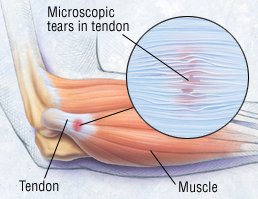 Tendonitis