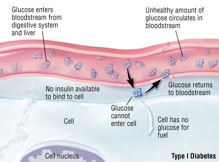 Type 1 diabetes is an autoimmune disease. This means it begins when 