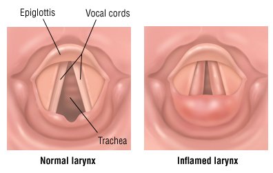 Steroids used to treat croup