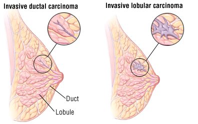 Women with breast cancer may overestimate secondary risks