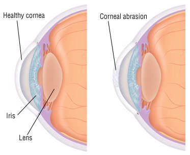 What To Do When Your Cornea Is Scratched