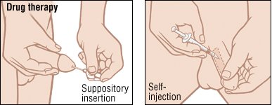 What is considered long term use of steroids