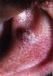 skin squamous cell carcinoma fluorouracil actinic cancer cream treatment topical symptoms warts genital term guide options risk affected treated drugs