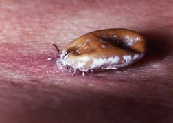tick bite lump tick bites guide causes symptoms and treatment options tick bite lump tick bites guide causes symptoms and treatment options
