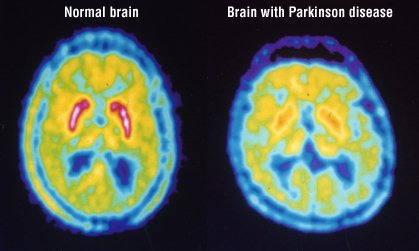 cardiac pet scan