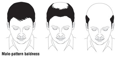 symptoms hair loss guide crown thinning