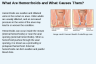 What Are Hemorrhoids and What Causes Them? What Are Hemorrhoids and What Causes Them?