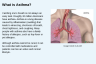 What is Asthma? What is Asthma?