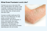 What Does Psoriasis Look Like? What Does Psoriasis Look Like?
