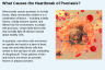 What Causes the Heartbreak of Psoriasis? What Causes the Heartbreak of Psoriasis?