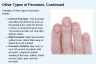 Other Types of Psoriasis, Continued Other Types of Psoriasis, Continued