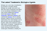 The Latest Treatments: Biologics Agents The Latest Treatments: Biologics Agents