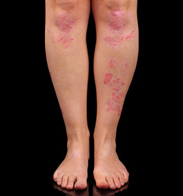 Over the counter corticosteroids for psoriasis