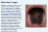 Black Hairy Tongue Black Hairy Tongue