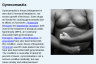 Gynecomastia Gynecomastia