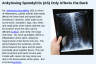 Ankylosing Spondylitis (AS) Only Affects the Back Ankylosing Spondylitis (AS) Only Affects the Back