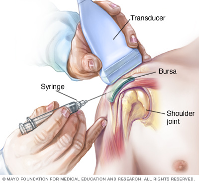 Injection steroid medication into tendon sheath