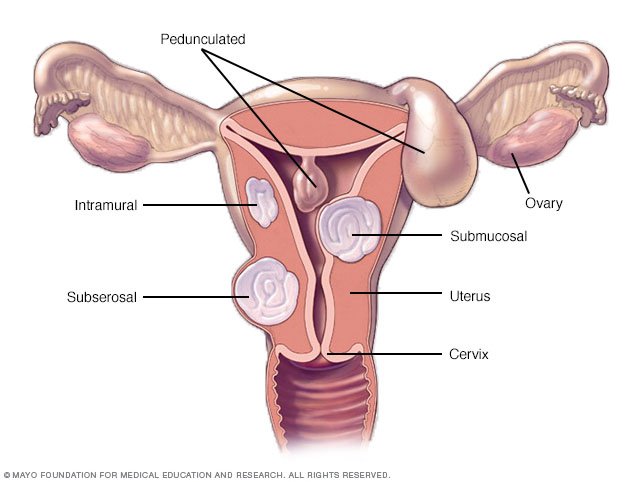 cervical cancer causes overlooked durations cancer cervix factores riesgo