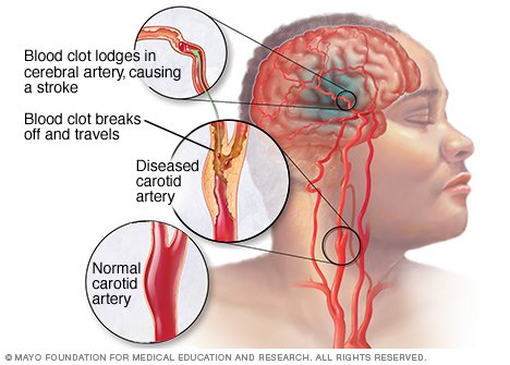 Causes And Symptoms Of Cerebral Vascular Accidents