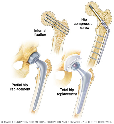 carisoprodol dosage guide with precautions after hip fracture carisoprodol dosage guide with precautions after hip fracture