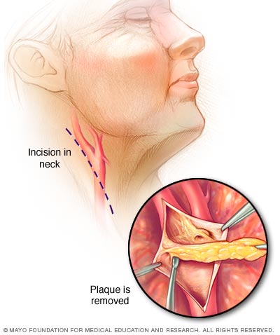 Sinus rinse ziko sinus drainage surgical procedure