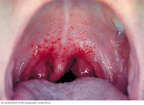 Strep throat wiki