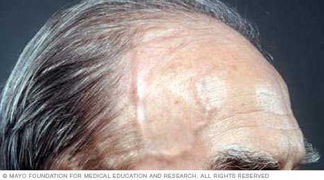 Vasculitis Disease Reference Guide - Drugs.com
